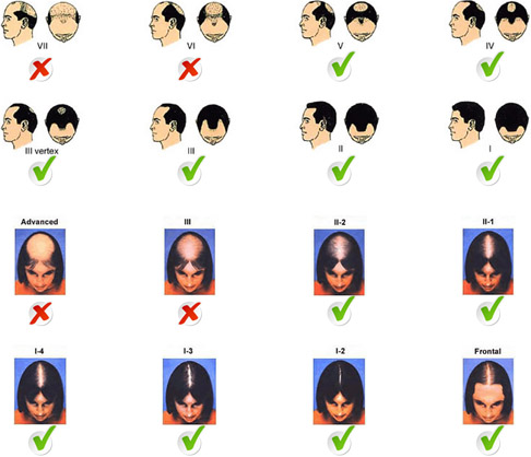male and female balding patterns image