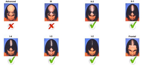 male and female balding patterns image