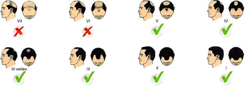 male and female balding patterns image